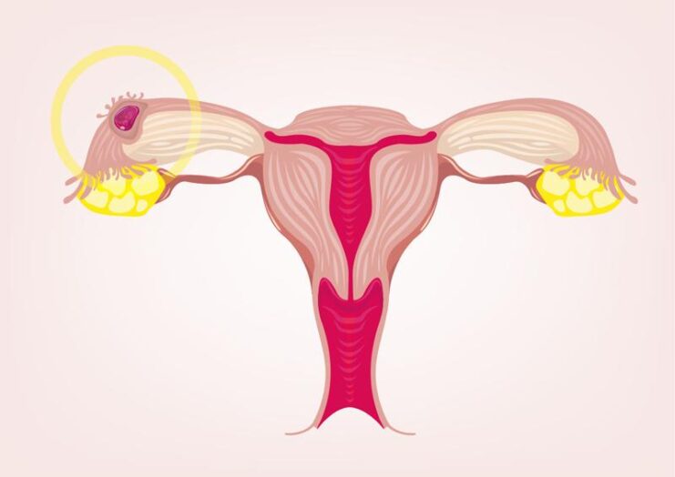 Ectopic pregnancy