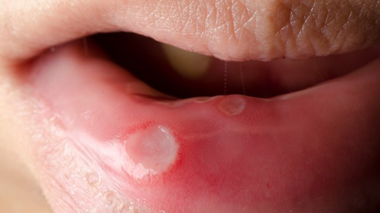 HIV Mouth Sores