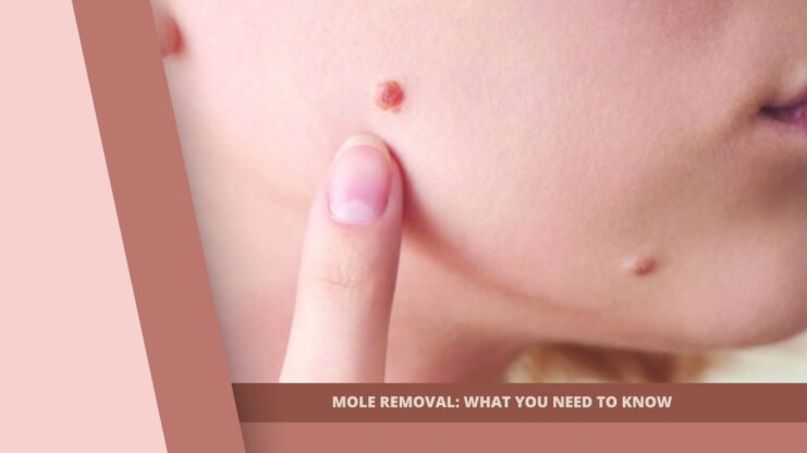 Mole removal
