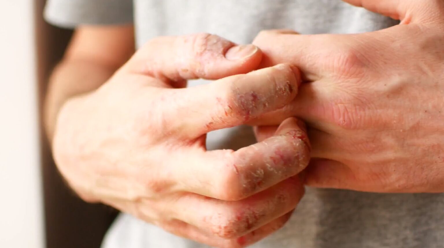 Rash on Penis – Penile Rash: Reclaim Your Confidence