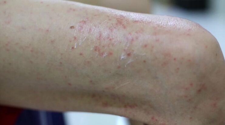 Skin conditions