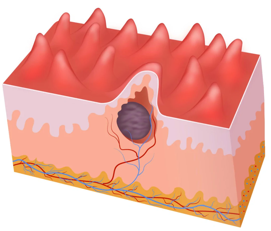 Pearly Penile Papules