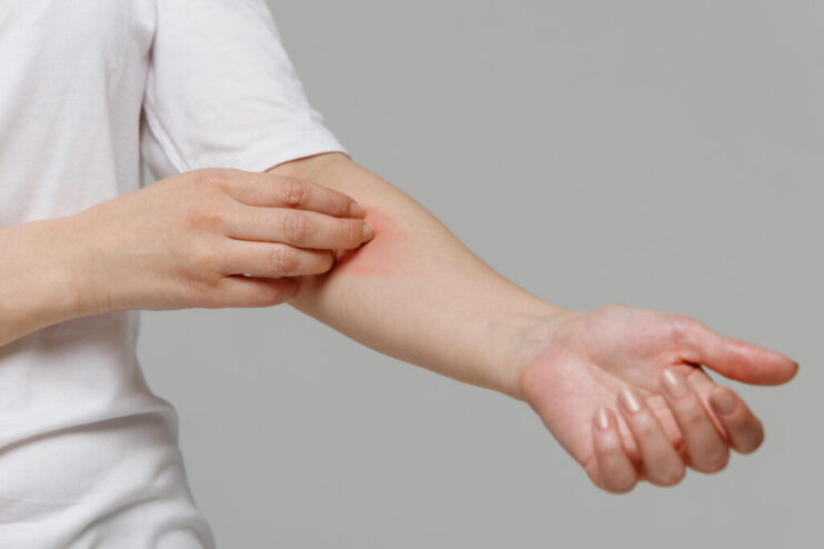 woman scratching the itch on her hand. Dry skin, animal/food all