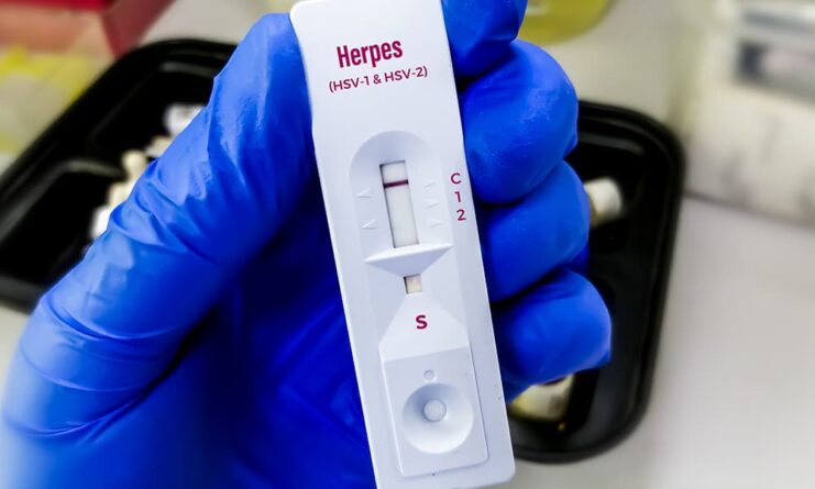 herpes-test