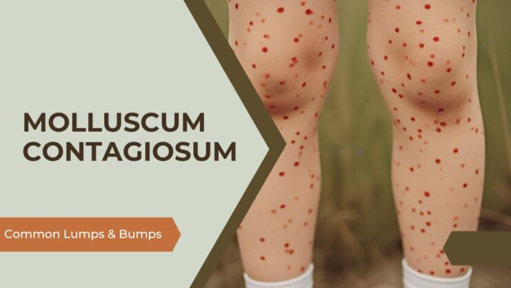 Molluscum Contagiosum - skin disease