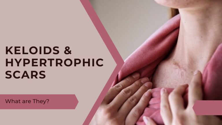 What are Keloids & Hypertrophic Scars - how to care for them