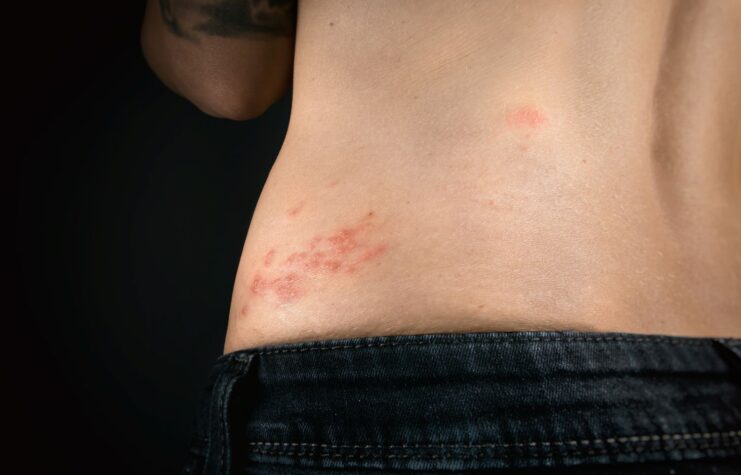 zoster pain shingles