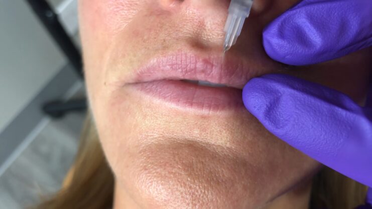 Lip Filler