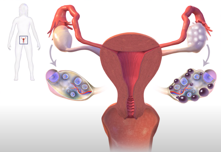 Polycistic ovary syndrom