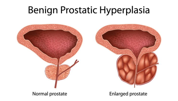 prostate